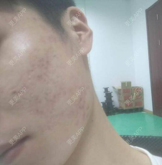 更美 - 更美用户ZRODyxl3kg的红蓝光清痘经验 | 红蓝光清痘 | 深圳