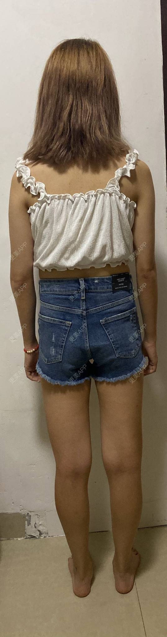 更美 - 更美用户8cJfwtNDeD的腹部吸脂经验 | 腹部吸脂