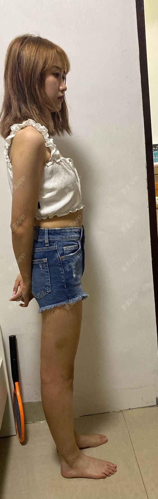 更美 - 更美用户8cJfwtNDeD的腹部吸脂经验 | 腹部吸脂