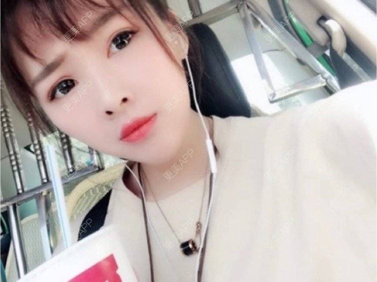 更美 - 更美用户Igf0wueJ8d的自体脂肪丰苹果肌经验 | 自体脂肪丰苹果肌 | 上海