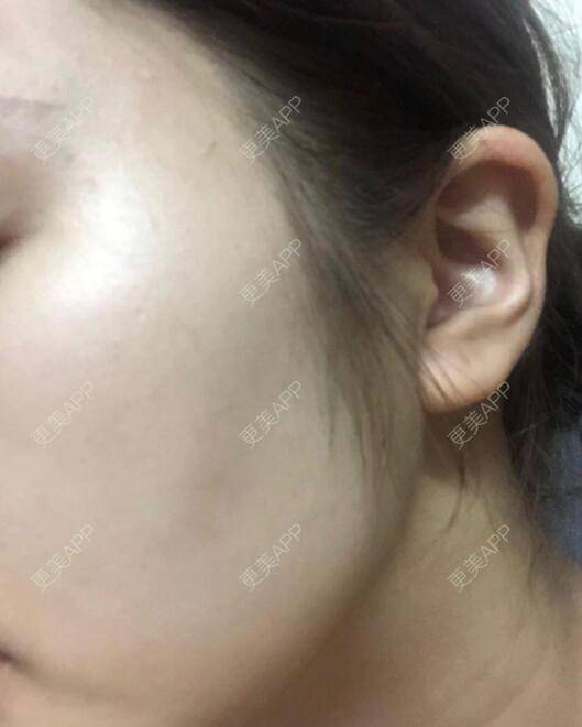 更美 - 更美用户EKDYB1uPQk的红蓝光清痘经验 | 红蓝光清痘 | 深圳