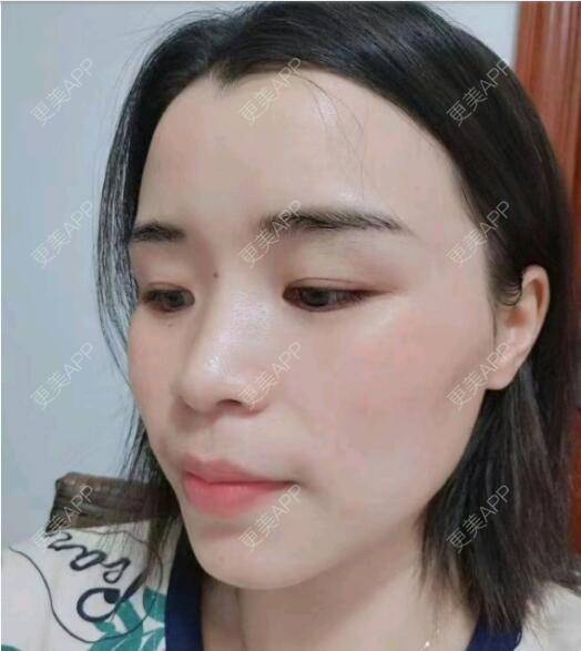 更美 - 更美用户pXkzwCTB8M的红蓝光清痘经验 | 红蓝光清痘 | 深圳