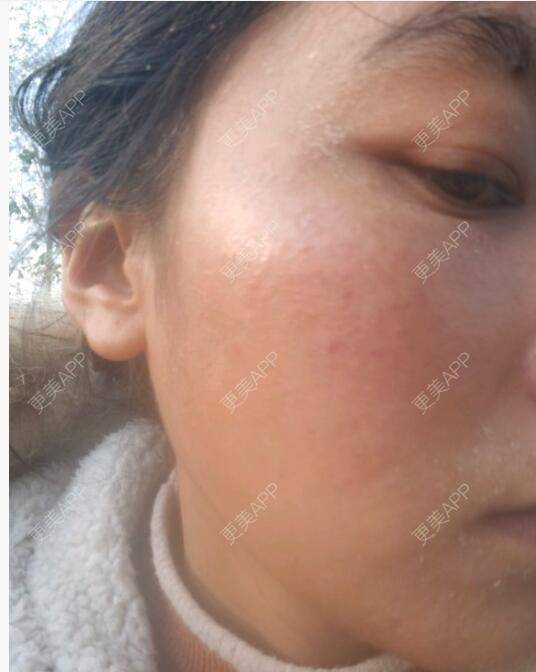 更美 - 更美用户OdhGdHfLSE的红蓝光清痘经验 | 红蓝光清痘 | 深圳