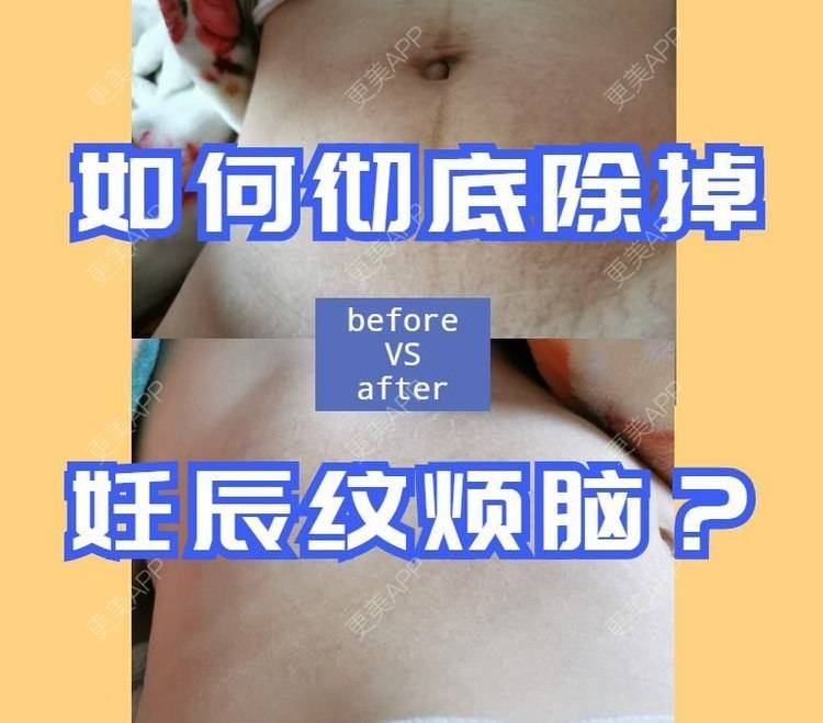 更美 - 桦桦子的产后塑形经验 | 皮肤综合管理套餐 | 注射淡疤 | 激光淡疤 | 激光淡斑 | 产后塑形 | 激光淡化妊娠纹 | 微针淡化妊娠纹 | 盆底肌修复 | 产后熏蒸