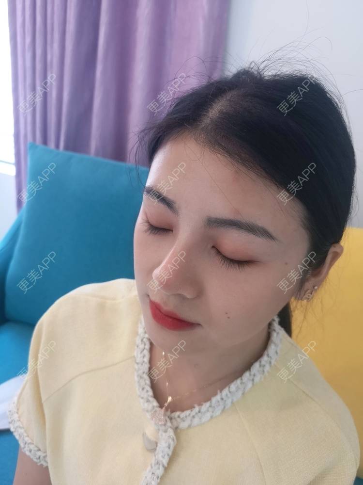 更美 - 更美用户riiy1Ld8RJ的鼻部综合经验 | 视频日记 | 深圳 | 鼻部综合
