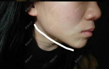更美 - 更美用户VrtouMnPU1的除皱瘦脸经验 | 除皱瘦脸 | 深圳