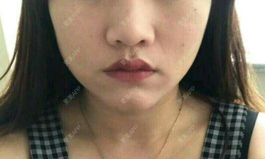 更美 - 更美用户Kkqy3lGGI6的除皱瘦脸经验 | 除皱瘦脸 | 深圳