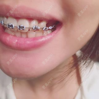更美 - 更美用户dFn65dQfvj的牙齿矫正经验 | 牙齿矫正