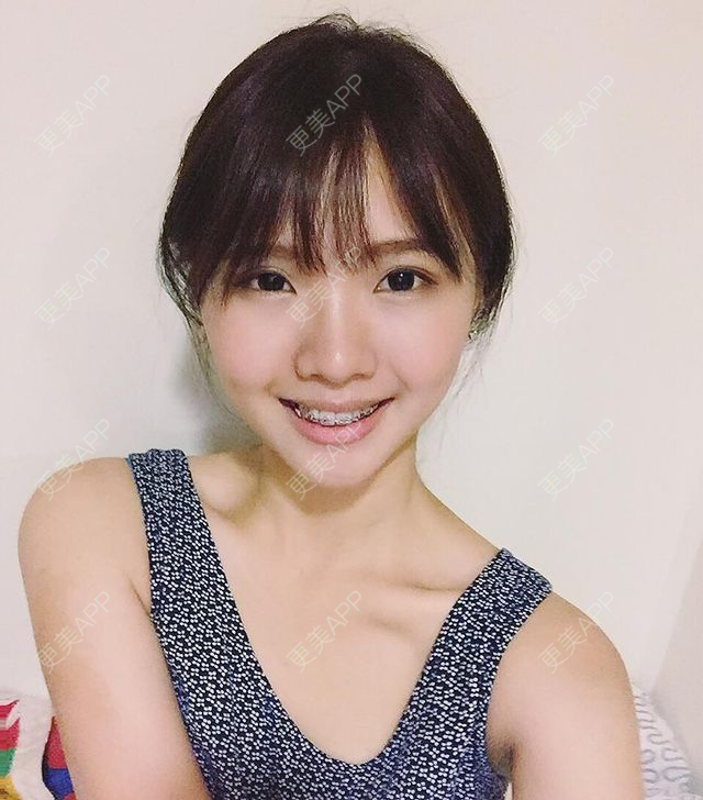 更美 - 更美用户dFn65dQfvj的牙齿矫正经验 | 牙齿矫正