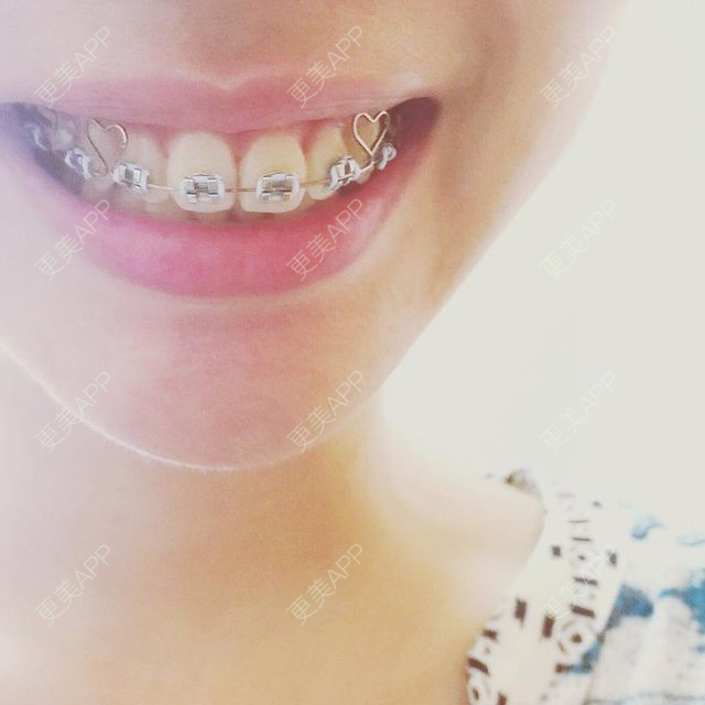 更美 - 更美用户dFn65dQfvj的牙齿矫正经验 | 牙齿矫正