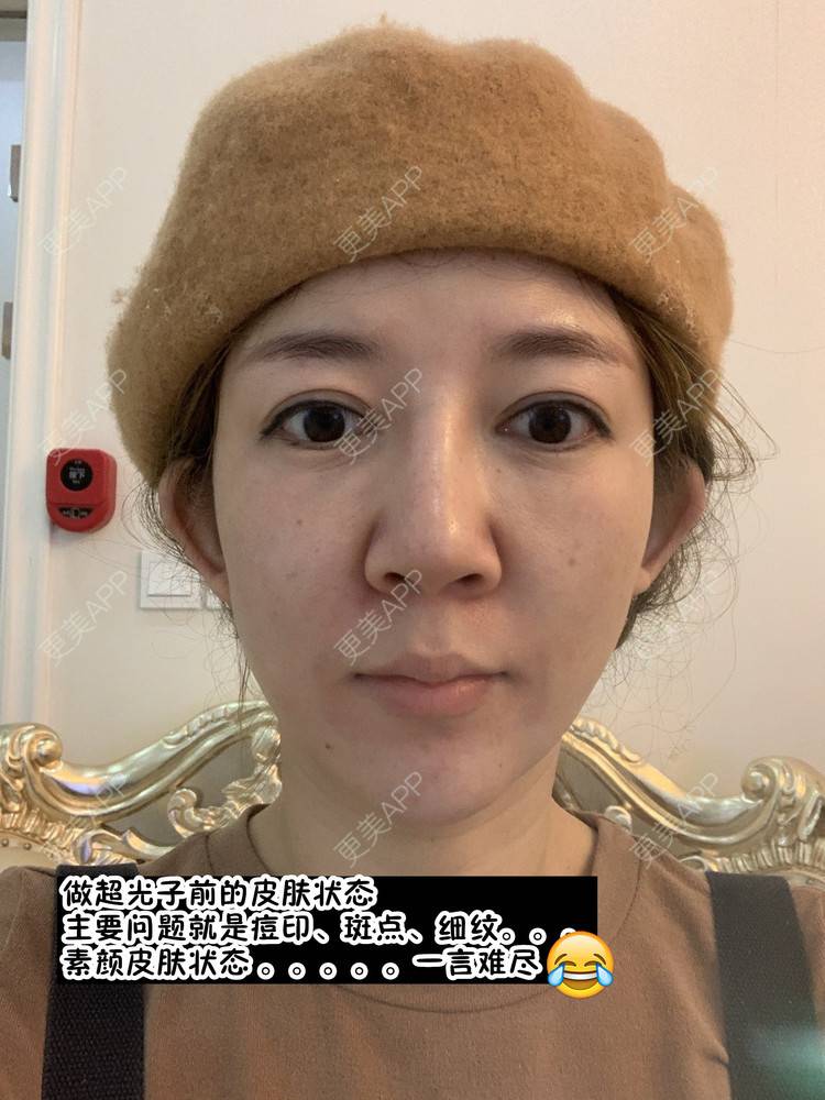 更美 - 更美用户d9qyRgUnbM的光子嫩肤经验 | 光子嫩肤 | 北京