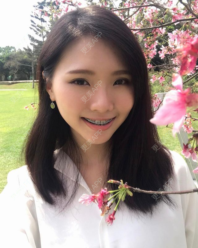 更美 - 更美用户dFn65dQfvj的牙齿矫正经验 | 牙齿矫正