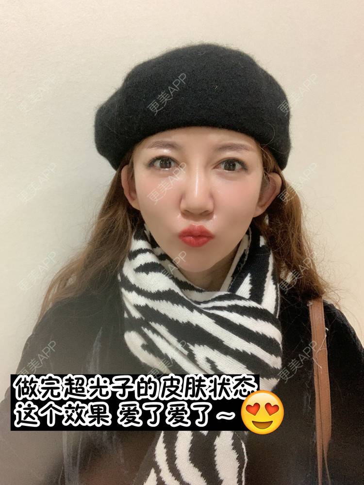 更美 - 更美用户d9qyRgUnbM的光子嫩肤经验 | 光子嫩肤 | 北京