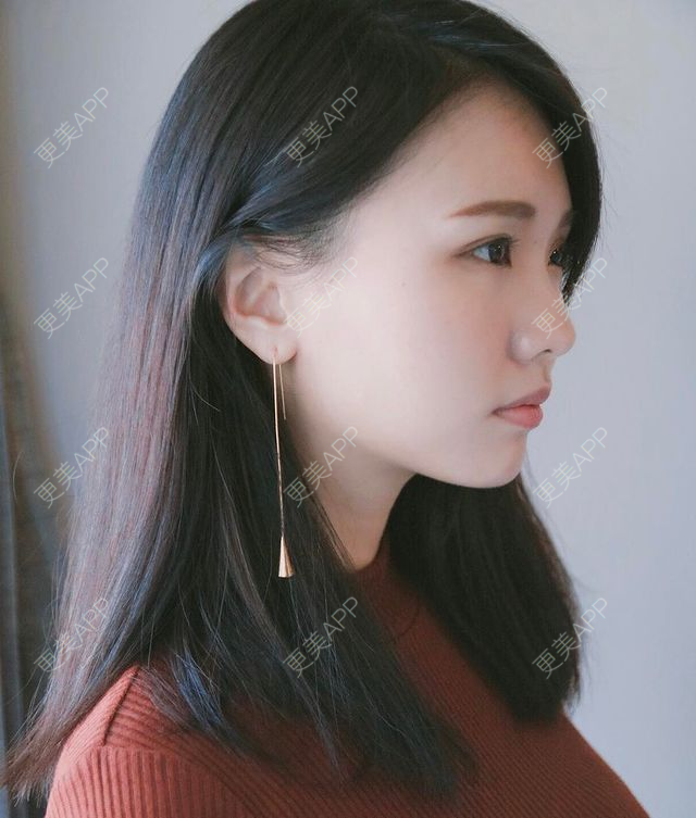 更美 - 更美用户dFn65dQfvj的牙齿矫正经验 | 牙齿矫正