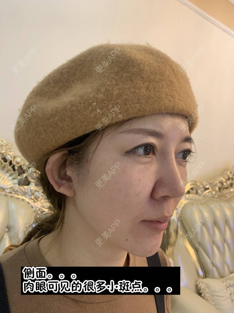 更美 - 更美用户d9qyRgUnbM的光子嫩肤经验 | 光子嫩肤 | 北京