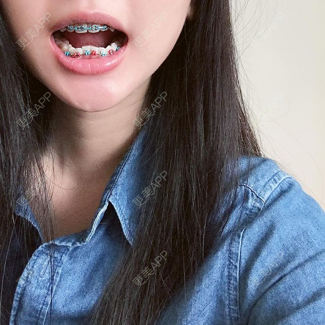 更美 - 更美用户dFn65dQfvj的牙齿矫正经验 | 牙齿矫正