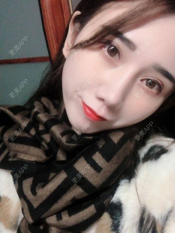 更美 - 半个柚子不加C的隆鼻经验 | 肋软骨隆鼻 | 鼻翼缩小 | 自体软骨垫鼻尖 | 鼻形态修复 | 鼻部多项 | 隆鼻 | 鼻中隔软骨垫鼻头 | 鼻中隔软骨隆鼻 | 鼻小柱延长 | 耳软骨隆鼻