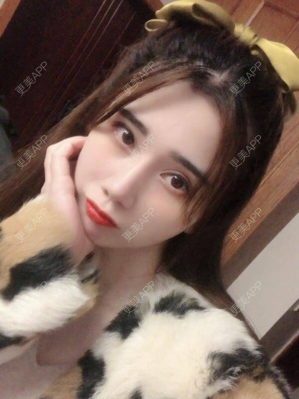 更美 - 半个柚子不加C的隆鼻经验 | 肋软骨隆鼻 | 鼻翼缩小 | 自体软骨垫鼻尖 | 鼻形态修复 | 鼻部多项 | 隆鼻 | 鼻中隔软骨垫鼻头 | 鼻中隔软骨隆鼻 | 鼻小柱延长 | 耳软骨隆鼻