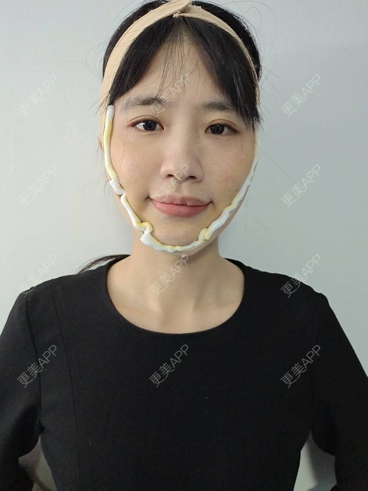 更美用户2g5c2lzews的双下巴吸脂日记