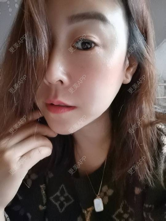 更美 - 更美用户JQiKDssKbO的玻尿酸颈纹经验 | 玻尿酸颈纹 | 重庆