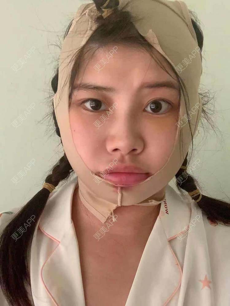 更美用户kx4xev5juo的颧骨颧弓日记