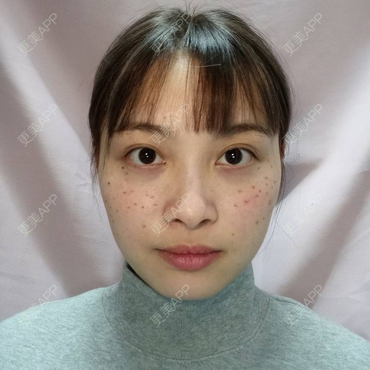 激光祛斑效果图_更美用户zaccu2tm1o激光祛斑效果图_术后308天__更美