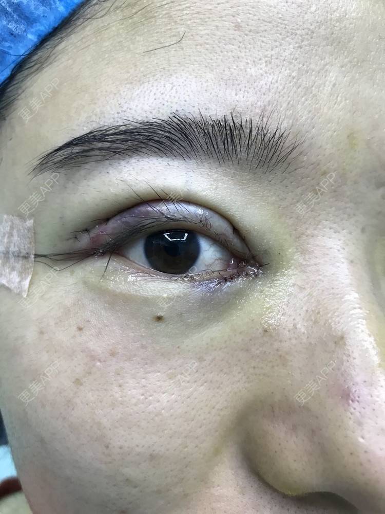 更美 - 更美用户lossoc8veb的全切双眼皮日记 | 全切双眼皮 | 开外