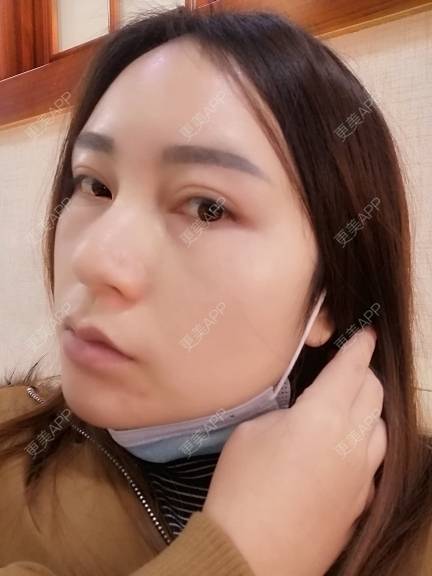 更美 - 更美用户35W00VbmuW的除皱瘦脸经验 | 除皱瘦脸 | 成都