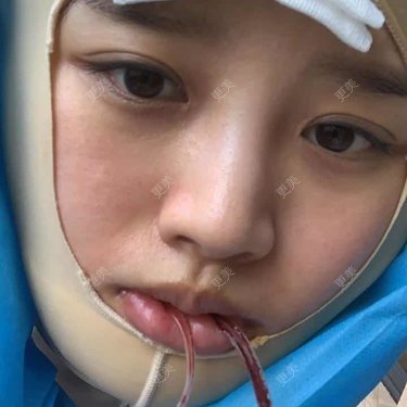 更美用户j6bmm7stdi的下颌角切除术日记