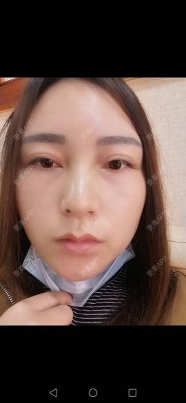 更美 - 更美用户35W00VbmuW的除皱瘦脸经验 | 除皱瘦脸 | 成都