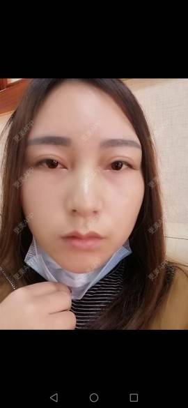 更美 - 更美用户35W00VbmuW的除皱瘦脸经验 | 除皱瘦脸 | 成都