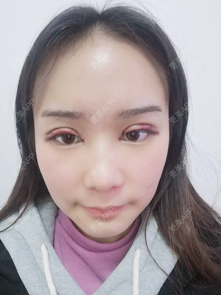 更美 - 鹿鹿不迷鹿的开内眼角日记 | 开内眼角 | 双眼皮修复 | 眶隔