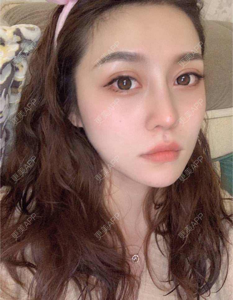 青岛华颜美医疗美容的鼻综合日记