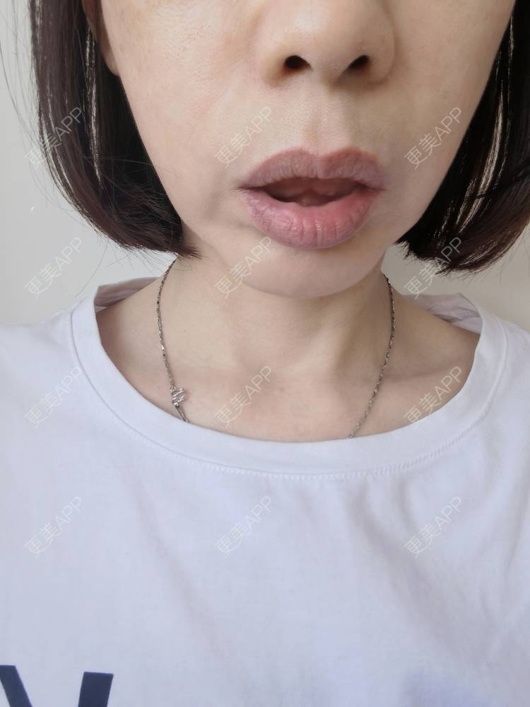 更美用户x6u7zrzmyz的膨体垫下巴日记