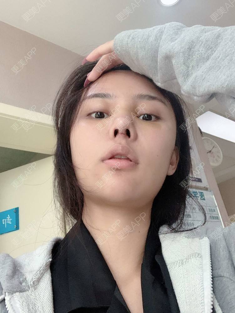 可乐乐乐乐的隆鼻假体取出日记