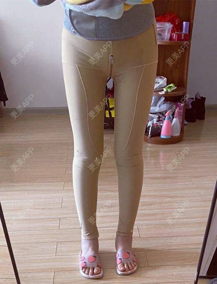 青岛华颜美医疗美容的大小腿吸脂日记