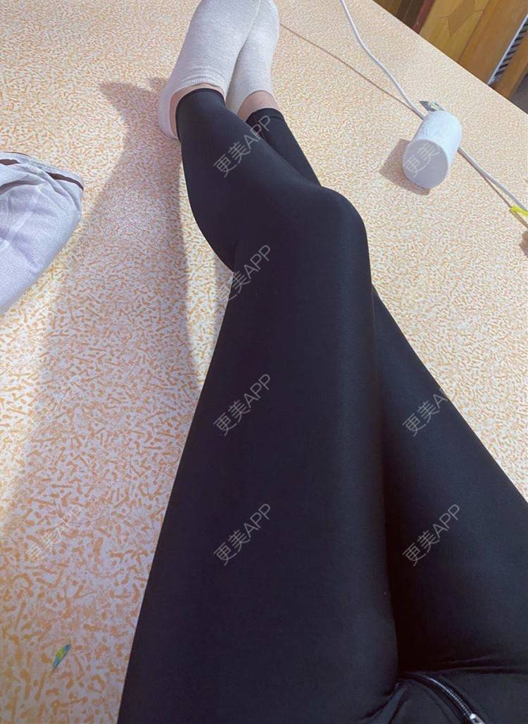 青岛华颜美医疗美容的大小腿吸脂日记