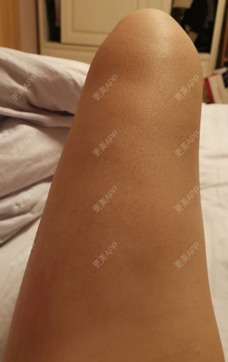 吸脂瘦大腿前后对比照_13*******33吸脂瘦大腿前后对比照_术后278天