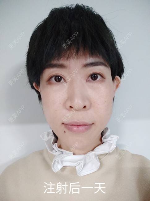 更美 - 可爱的王潇潇的玻尿酸太阳穴经验 | 淄博 | 玻尿酸全面部