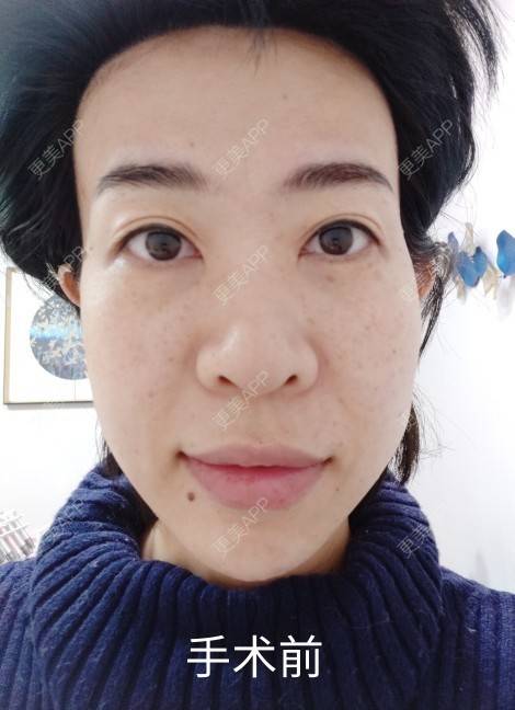 更美 - 可爱的王潇潇的玻尿酸太阳穴经验 | 淄博 | 玻尿酸全面部