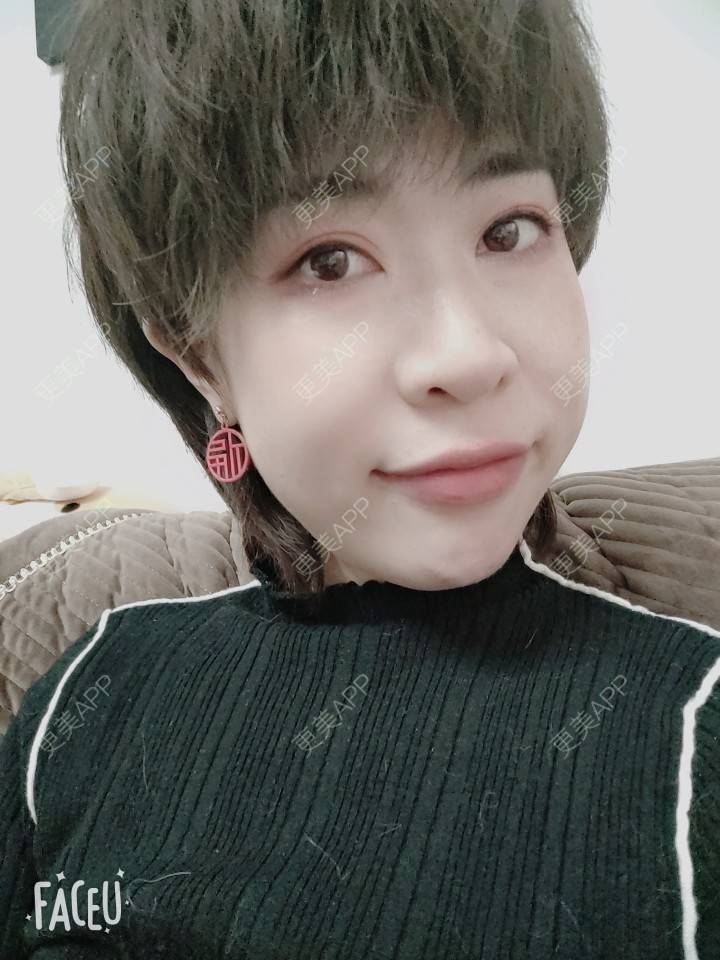 更美 - 可爱的王潇潇811的玻尿酸太阳穴经验 | 淄博 | 玻尿酸全面部