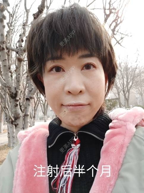 更美 - 可爱的王潇潇811的玻尿酸太阳穴经验 | 淄博 | 玻尿酸全面部