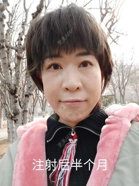 更美 - 可爱的王潇潇811的玻尿酸太阳穴经验 | 淄博 | 玻尿酸全面部