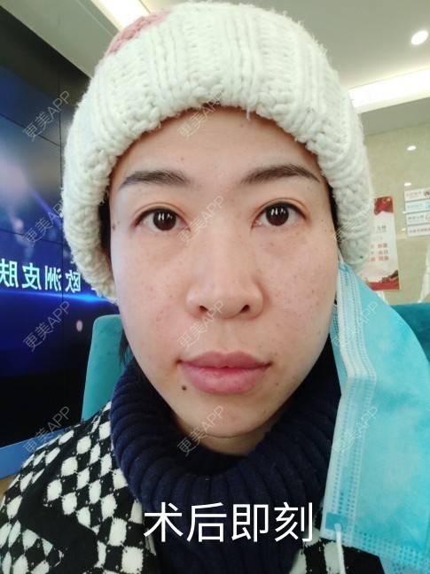 更美 - 可爱的王潇潇811的玻尿酸太阳穴经验 | 淄博 | 玻尿酸全面部
