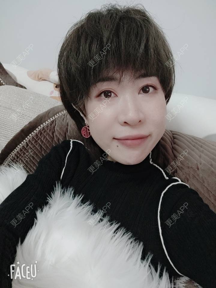 更美 - 可爱的王潇潇811的玻尿酸太阳穴经验 | 淄博 | 玻尿酸全面部
