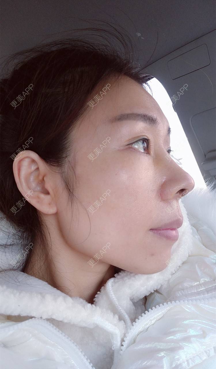 更美用户3qdj234bf2的肋软骨隆鼻日记