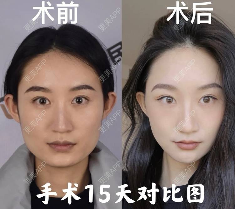 更美用户zlcfwmqvp6的颧骨内推日记