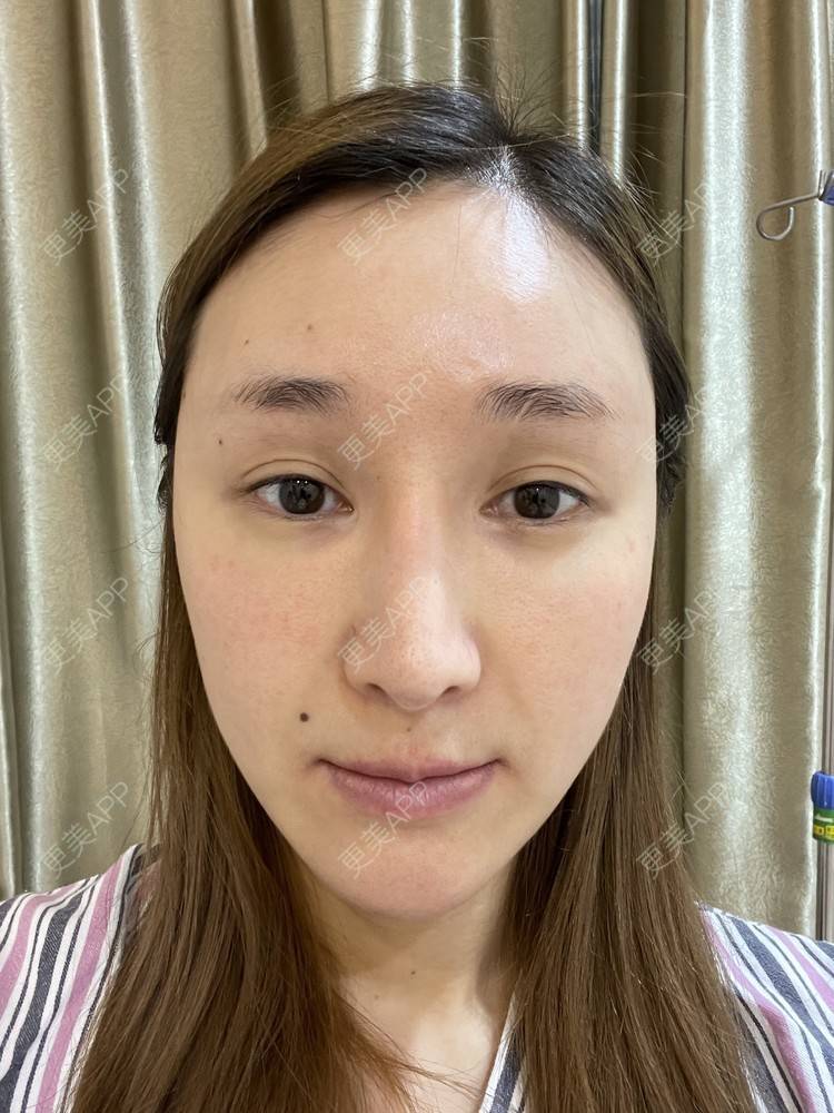 小燕燕呀的自体脂肪填充泪沟日记