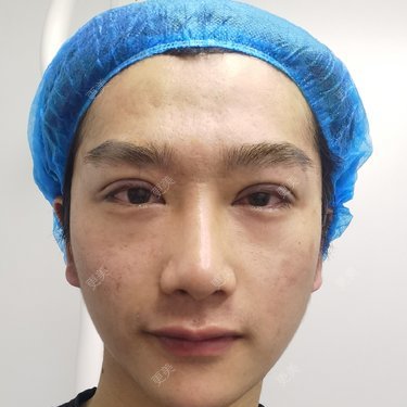 爱变帅的正正的全切双眼皮日记