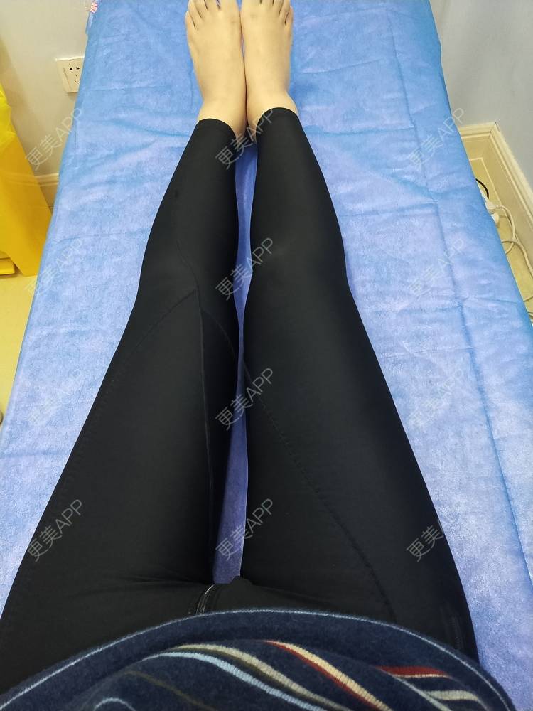 吸脂瘦大腿图片_晴大王吸脂瘦大腿图片_术后322天__更美